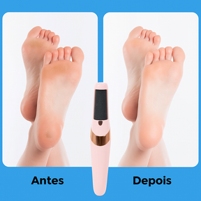 SoftFeet™ - Removedor de Calos Elétrico